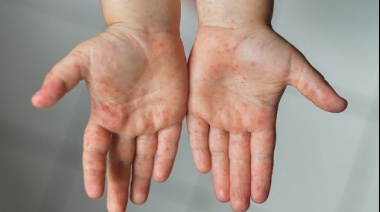 Sarampión: recomiendan una dosis extra de vacuna en niños
